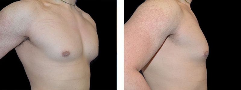 Example photos of chest from front and side